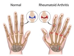 Rheumatoid Arthritis Natural Treatment With Acupuncture Robbinsdale, MN